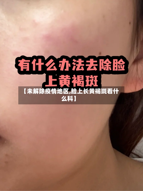 【未解除疫情地区,脸上长黄褐斑看什么科】